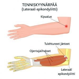 Tenniskyynärpää Lateraali epikondylitti