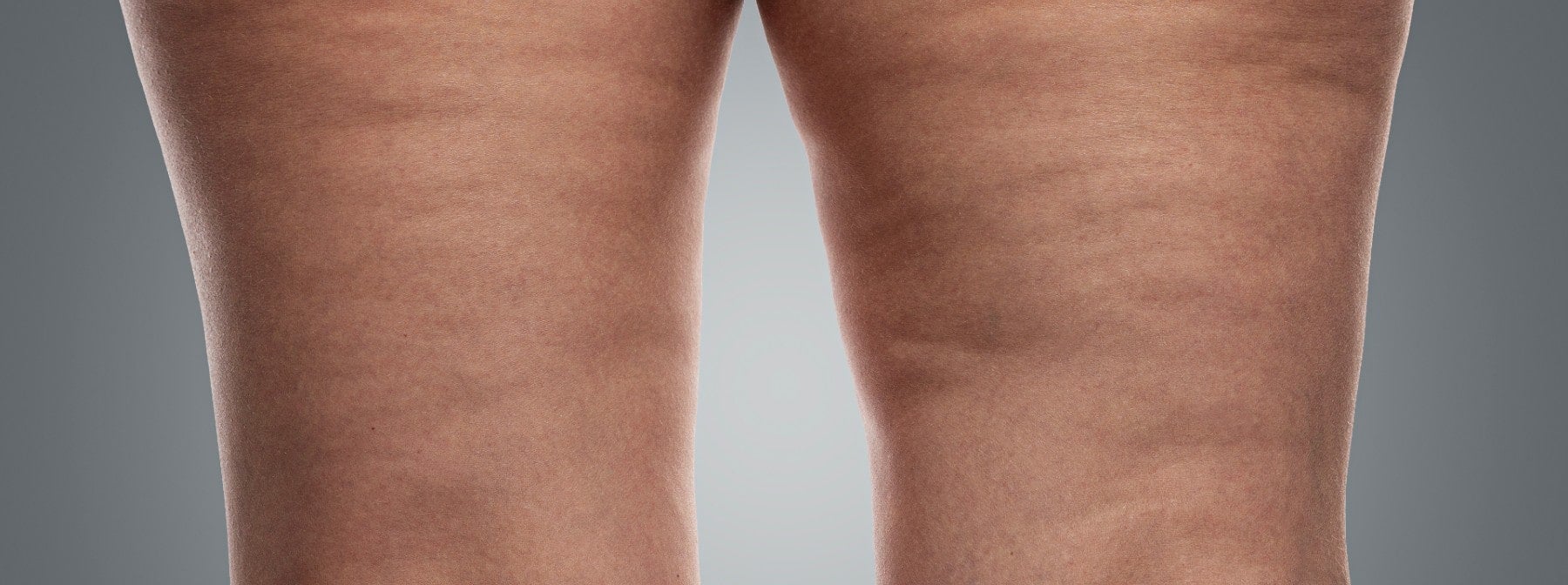 Wie man Cellulite "los wird" | Wissenschaftlicher Fakt oder Fiktion