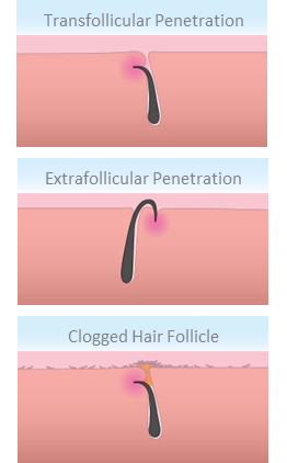 Diagram of an ingrown hair under the surface of the skin | Gillette UK